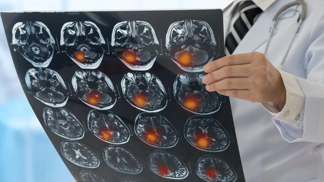 8 Ciri-Ciri Tumor Ganas pada Otak, Ketahui Penyebab dan Pengobatannya