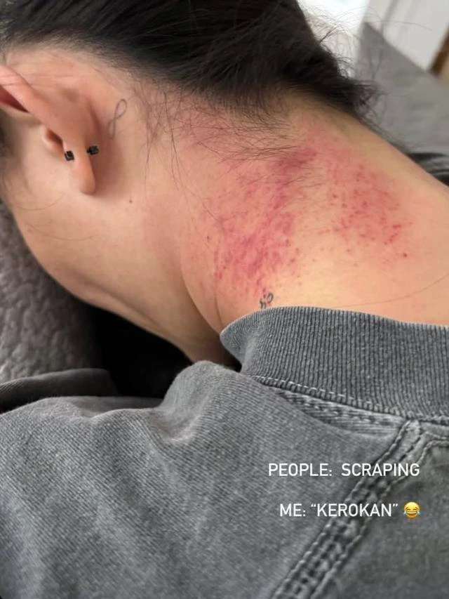 Agnez Mo Sempat Bikin Heboh Usai Unggah Foto Leher Memerah, Ketahui Manfaat dan Risiko dar...