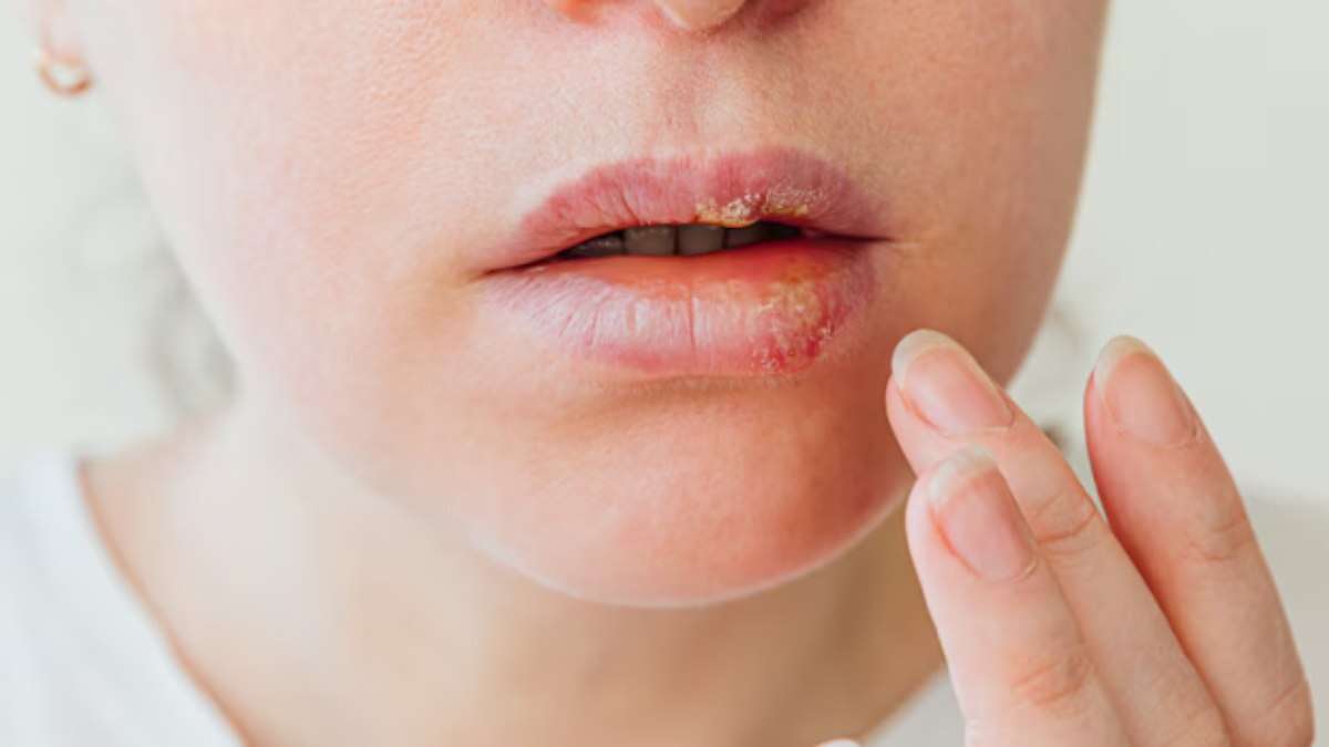 O verão está chegando: atenção ao herpes labial