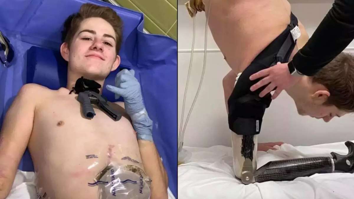 Jovem tem corpo cortado ao meio por empilhadeira e mostra como vive após acidente; veja