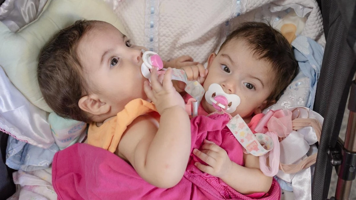 Goiás: gêmeas siamesas são internadas para cirurgia de separação