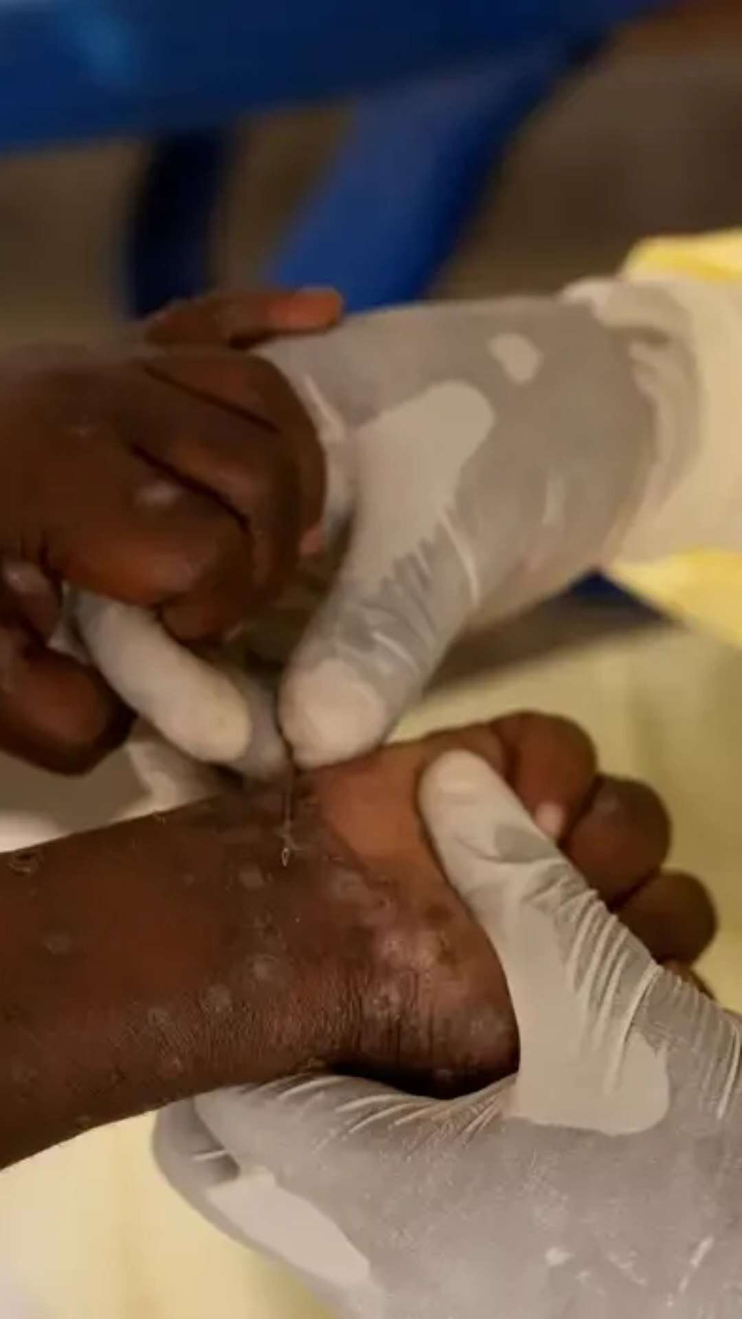 Mpox: entenda a transmissão e os riscos além das infecções sexualmente transmissíveis