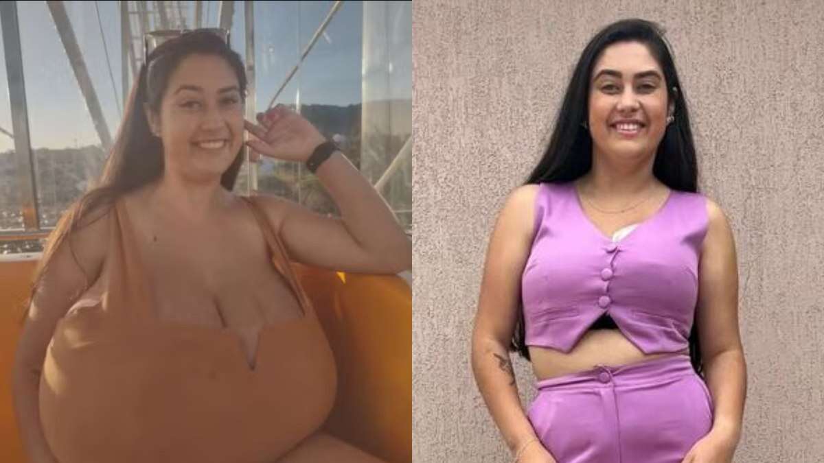 Jovem com gigantomastia faz cirurgia e retira 10 kg de mama no Paraná