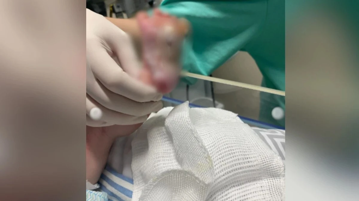 Recém-nascido sofre queimadura grave no pé em hospital do ES