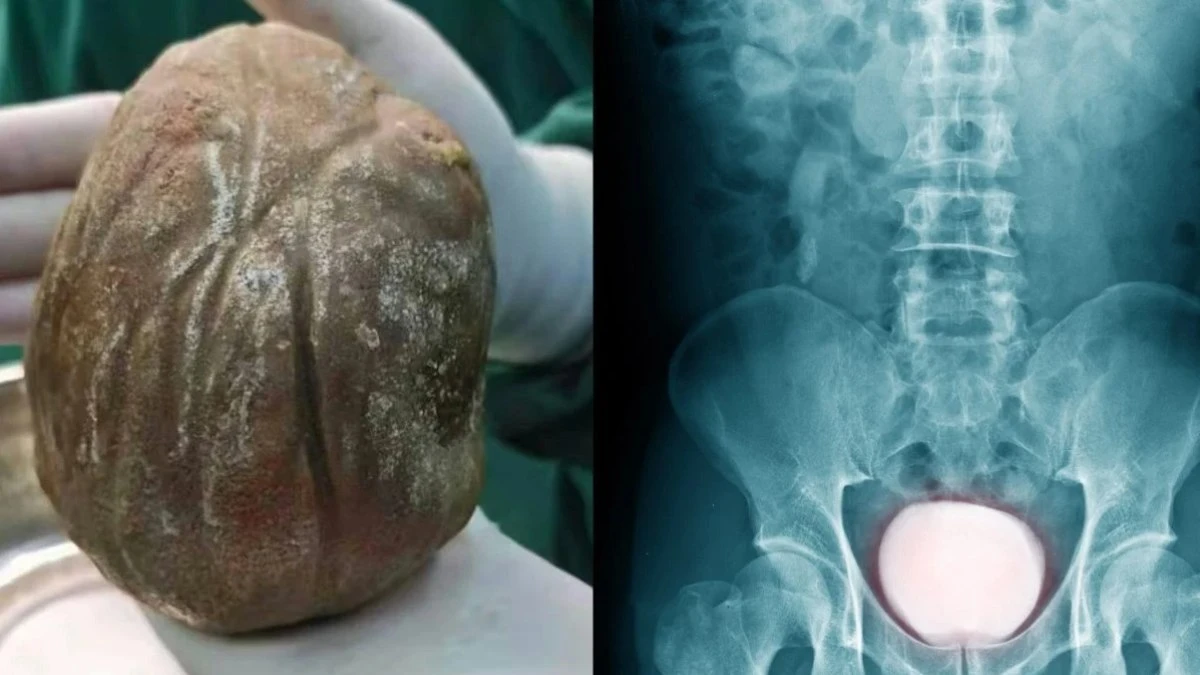 Pedra gigante de 1,3kg é retirada da bexiga de homem