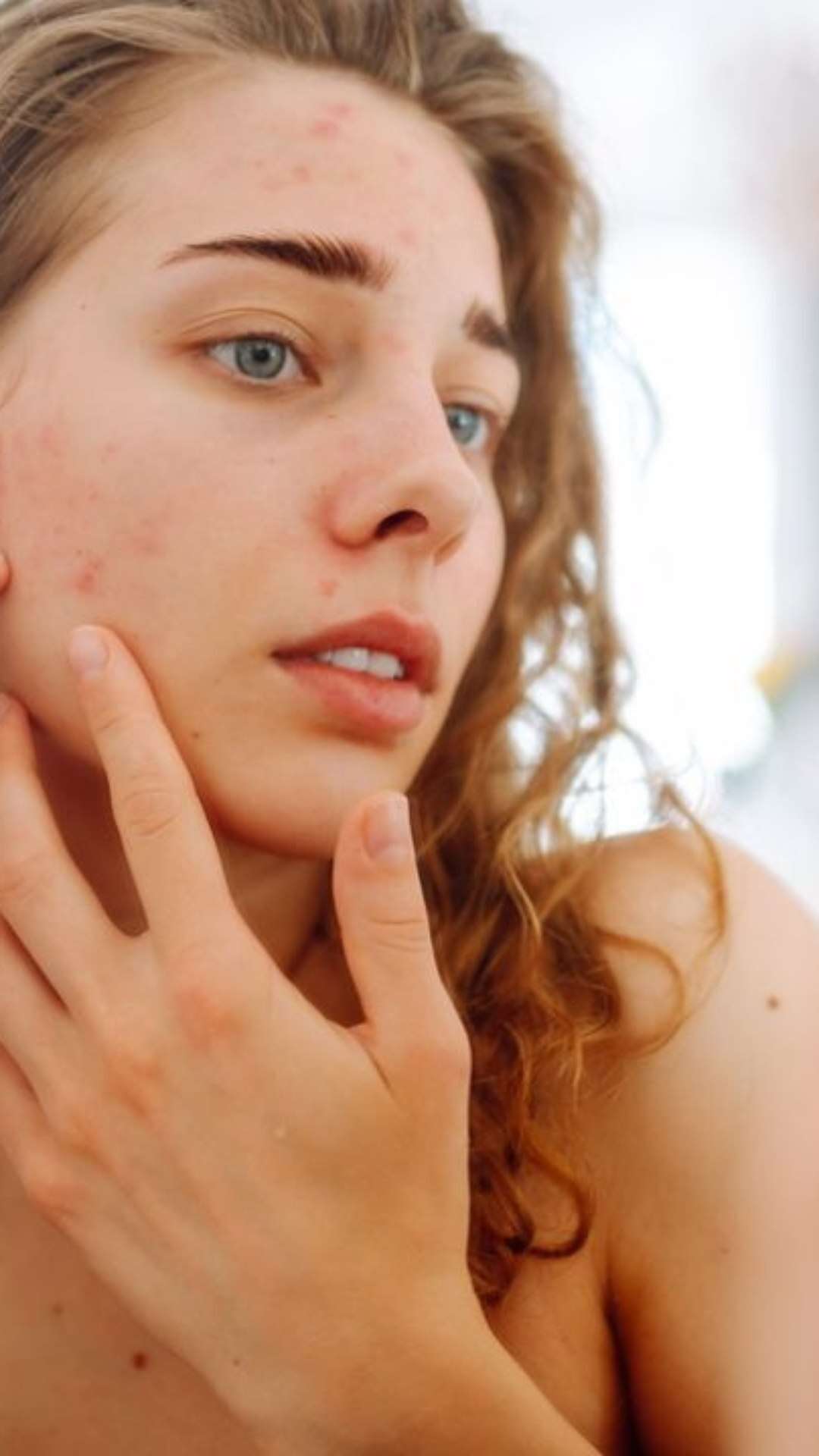 Celebridades revelam problema com acne; veja como evitar