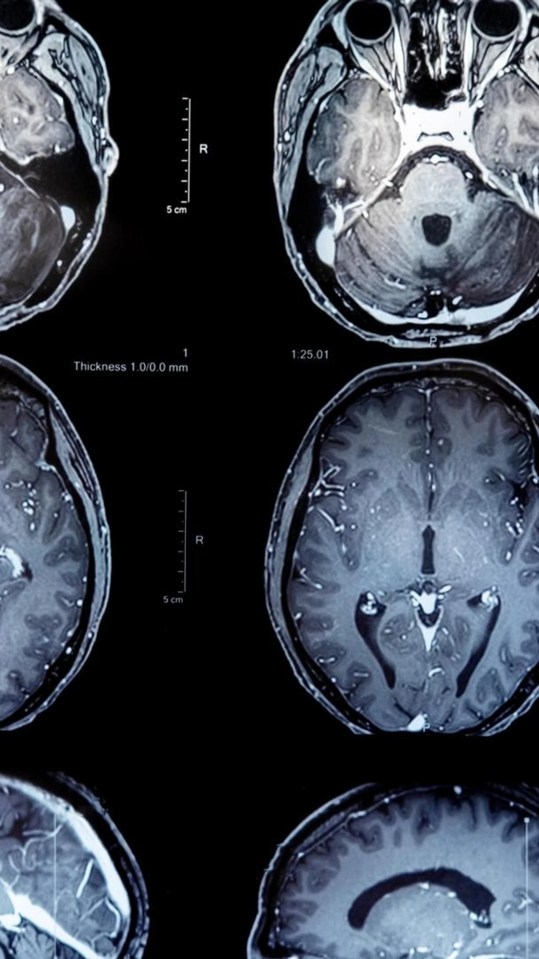 Vacina é a nova esperança contra tumores cerebrais