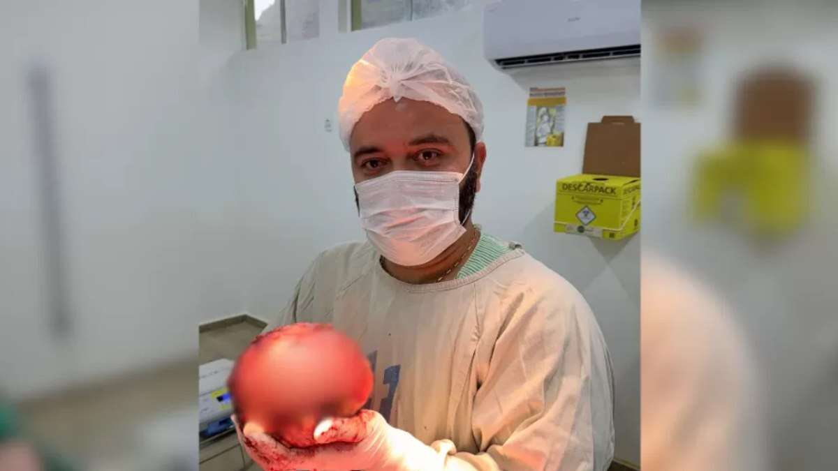 “Maior que já vi”, diz médico obstetra após remover tumor de quase 2 kg de paciente