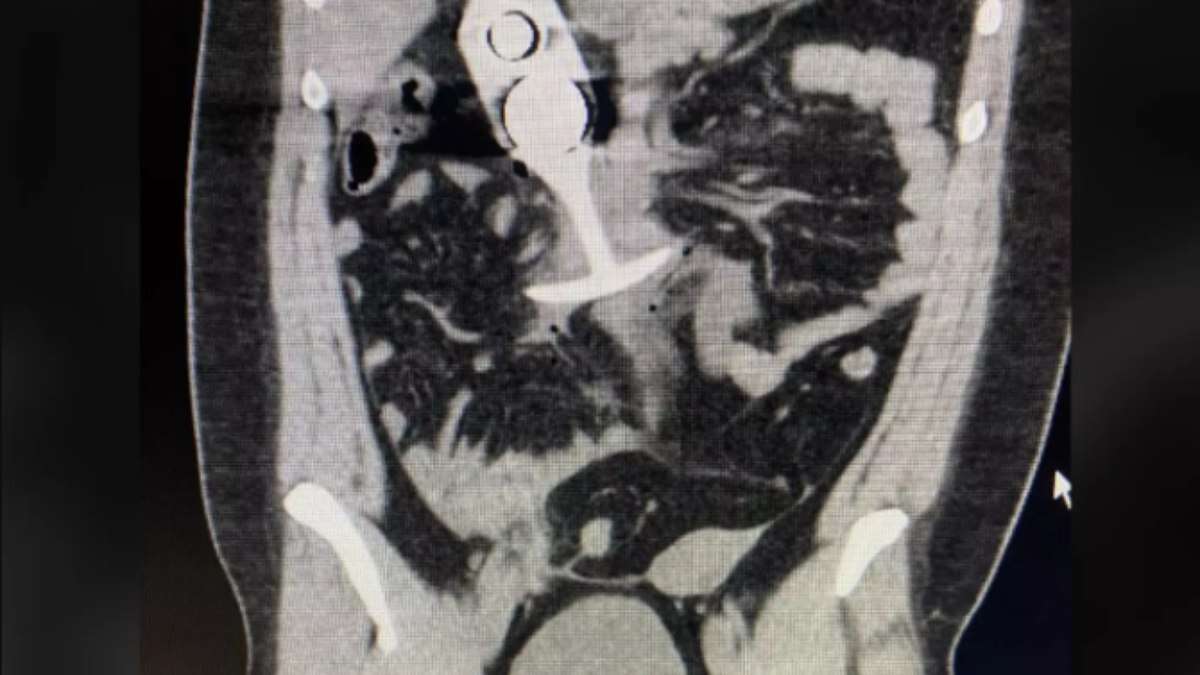 Mulher deixa brinquedo adulto no corpo em ressonância magnética; resultado é desastroso