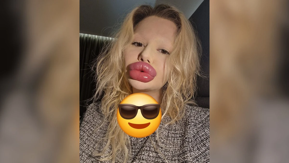 Antes e depois de mulher com lábios gigantes chama atenção da web