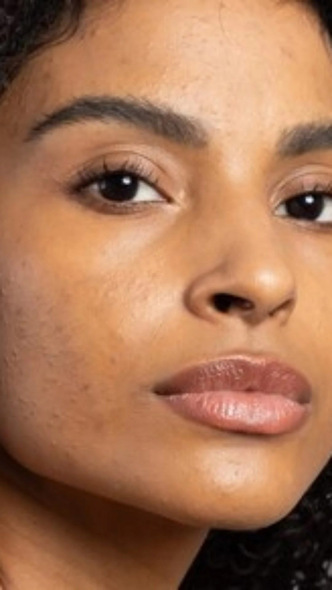 Mês da Acne: conheça os ativos mais eficazes para cuidar da pele acneica
