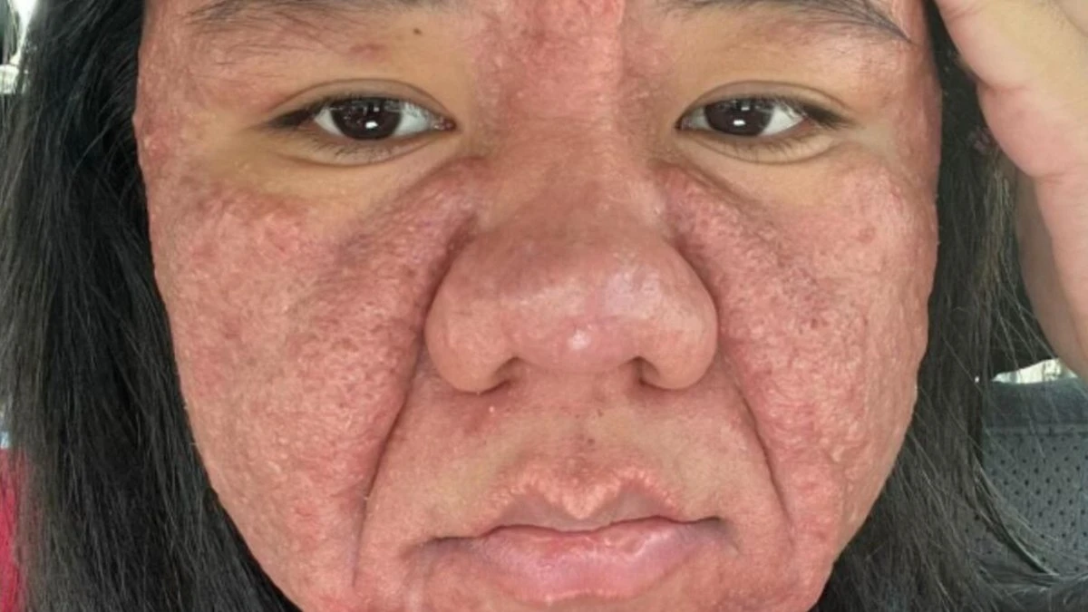 Acne gravídica: como a gravidez afeta a pele da gestante