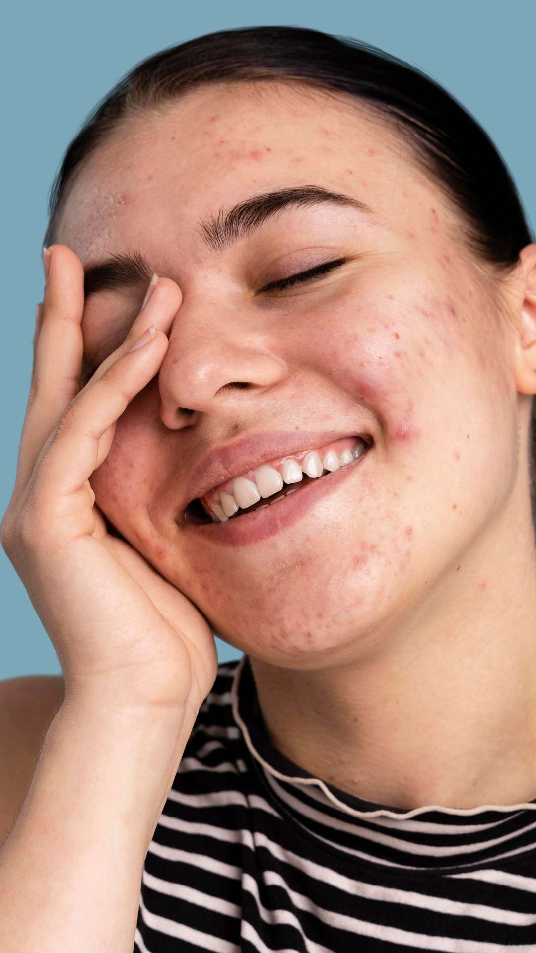 Bebidas para reduzir a acne: estudos apontam 5 opções eficazes