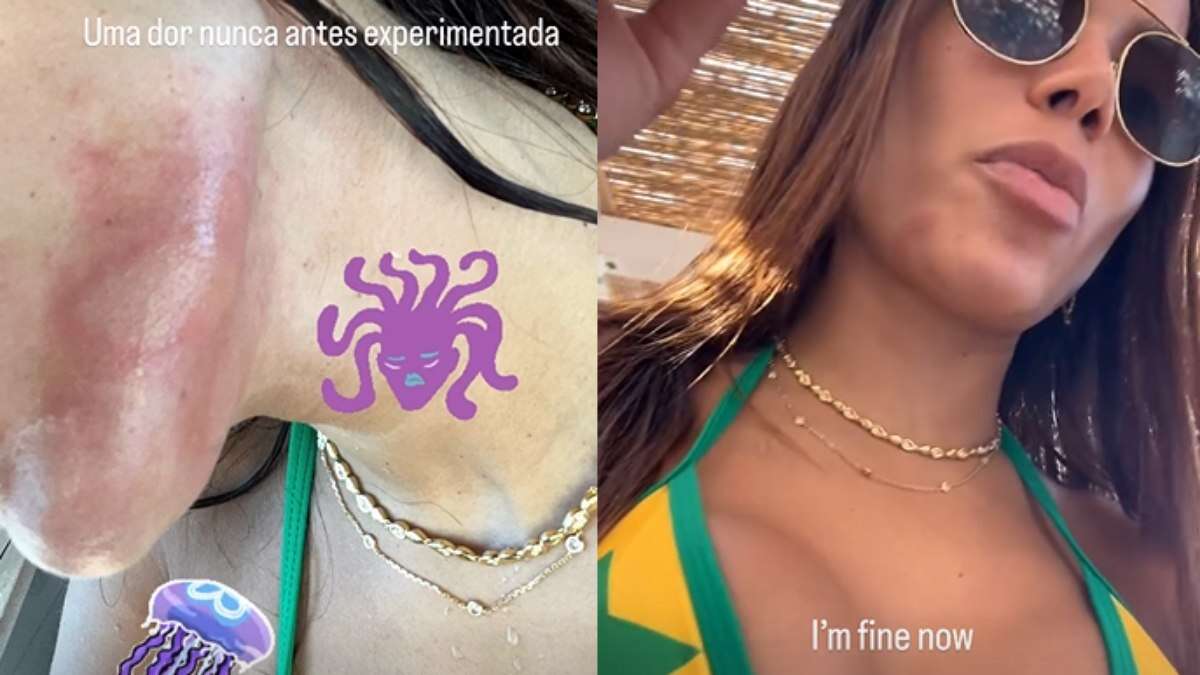 Queimadura de água-viva pode matar? Saiba risco que Anitta sofreu ao lutar com uma