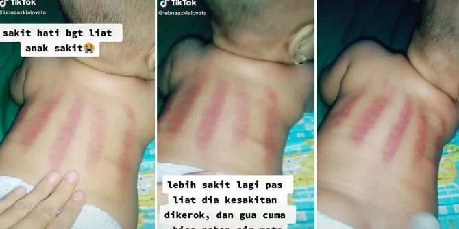 Viral Curhatan Ibu, Bayi Sakit Pilih Dikerok Dukun Beranak Sampai Merah & Kesakitan