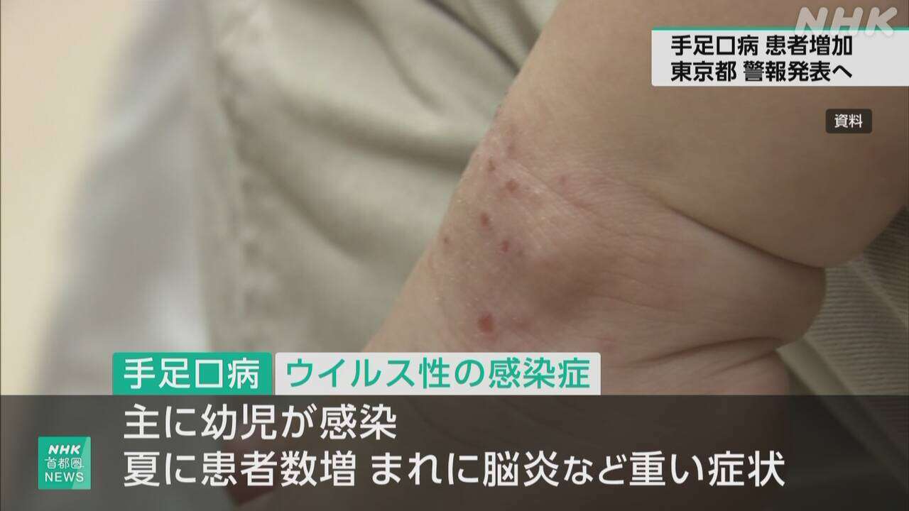 手足口病 患者数が基準上回り 東京都が警報発表へ 感染対策を