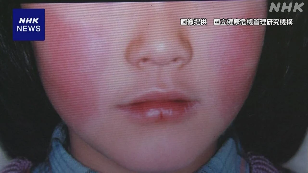リンゴ病流行 1週間の患者数が過去最多 1医療機関当たり2.05人