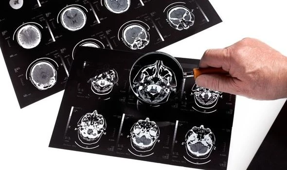 Alzheimer’s breakthrough as revolutionary drug-free treatment available in UK
