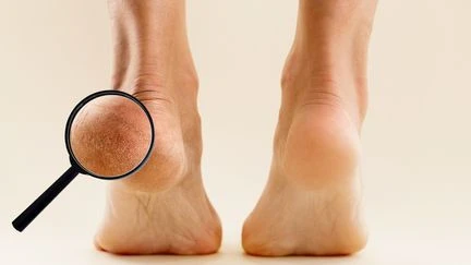 Pourquoi vos pieds sentent-ils le fromage ?