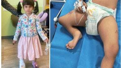 Nosaiba finalmente cammina: dalla Libia al Galeazzi, la bambina di tre anni operata per una grave malformazione al piede