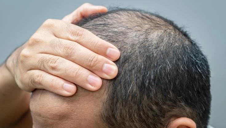 Finasteride, alert EMA: pensieri suicidari tra i possibili effetti collaterali del farmaco