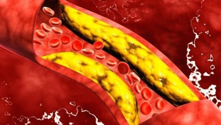 Un test 'ad personam' dice quanto è davvero 'cattivo' il colesterolo