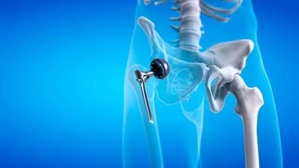 Protesi all'anca, la sostituzione totale migliora la qualità della vita