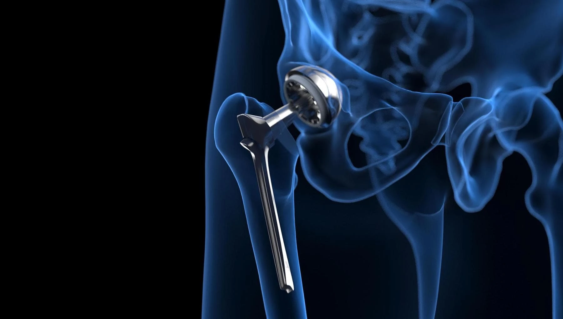 Protesi all’anca, se i muscoli stanno bene il recupero è migliore