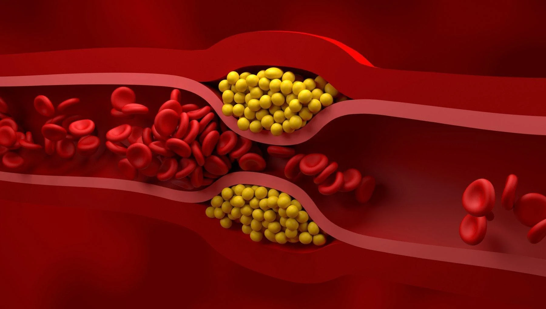 Terapia su misura: così può calare il rischio d’infarto (e non solo) dopo l’angioplastica