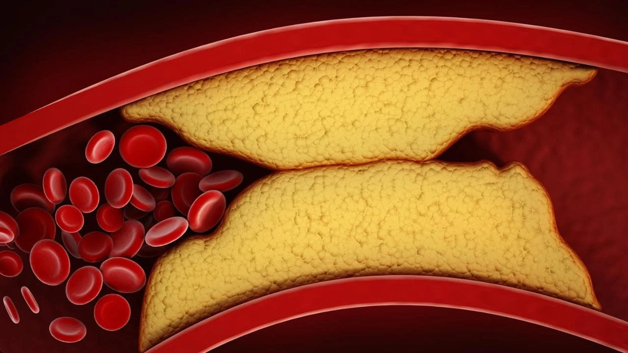 Infarto e ictus, così il colesterolo cattivo che va su e giù aumenta il rischio