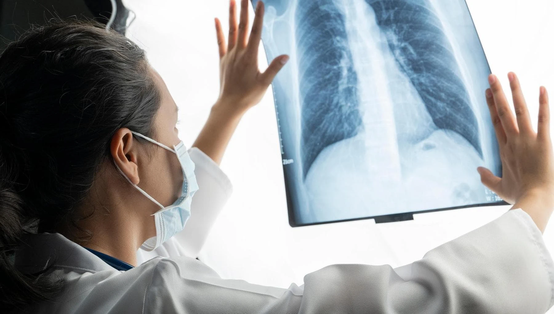 Tumore del polmone, una nuova terapia mirata al posto della chemio