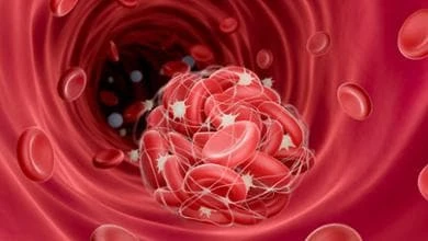 Ictus ischemico, grazie ai farmaci si può sciogliere il trombo (ma se si fa presto)