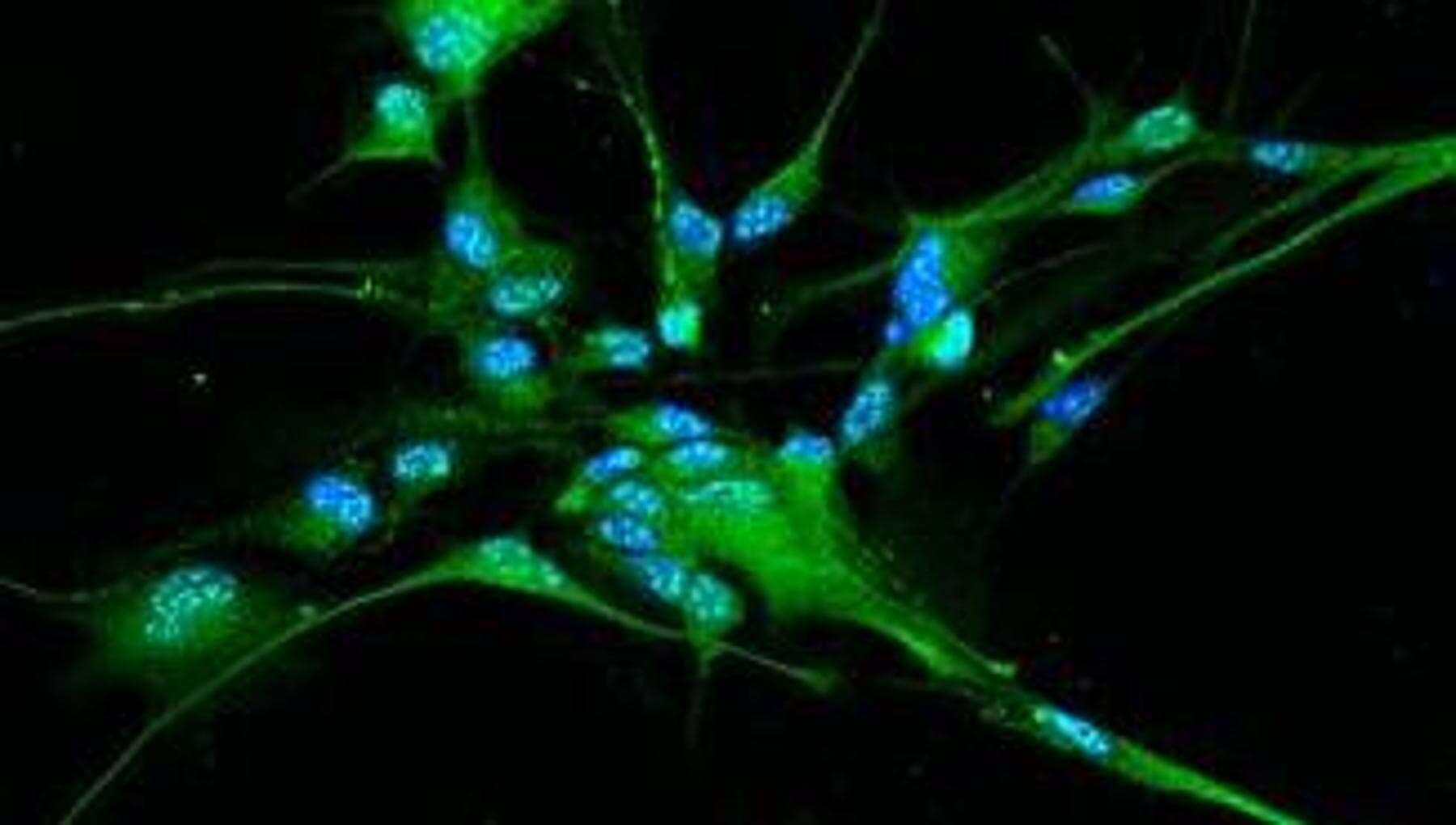 Glioblastoma, scoperto un meccanismo che favorisce la proliferazione delle cellule tumorali