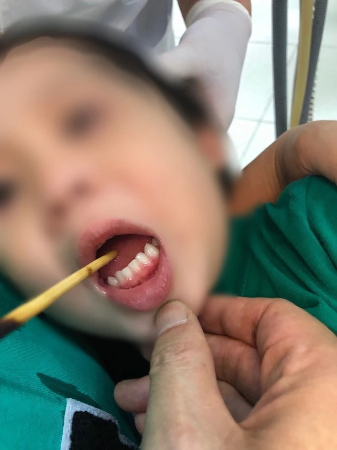 Ngã lúc chơi đùa, bé gái 3 tuổi bị que xiên thịt đâm xuyên lưỡi