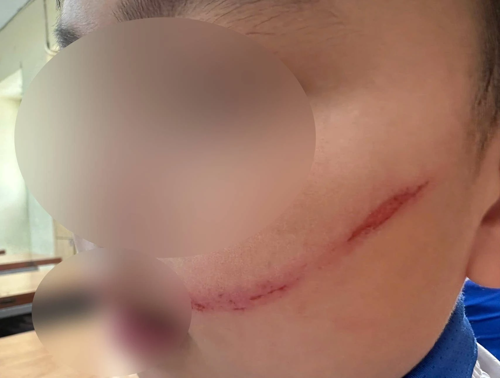 Nhìn 2 vết xước trên mặt học sinh Hà Nội này mà xót: Câu chuyện phía sau thổi bùng tranh luận