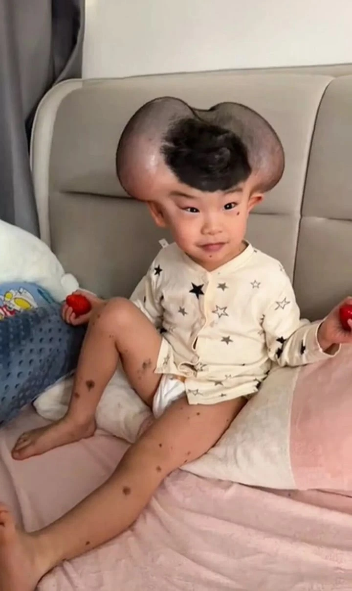 Nốt ruồi khổng lồ phủ kín hộp sọ khiến cậu bé có ngoại hình giống chuột Mickey