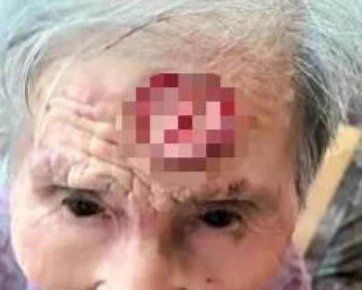 Cụ bà 98 tuổi dùng kéo cắt 'sừng trường thọ' trên trán, dẫn đến nguy kịch
