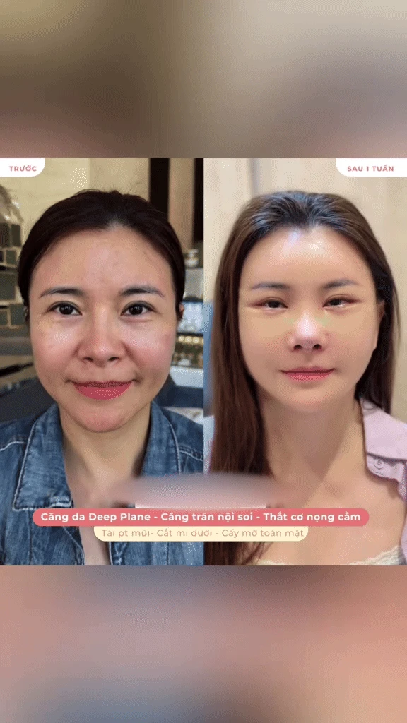 Diễn viên Kim Oanh lên tiếng sau khi gây tranh cãi vì phẫu thuật thẩm mỹ cả gương mặt