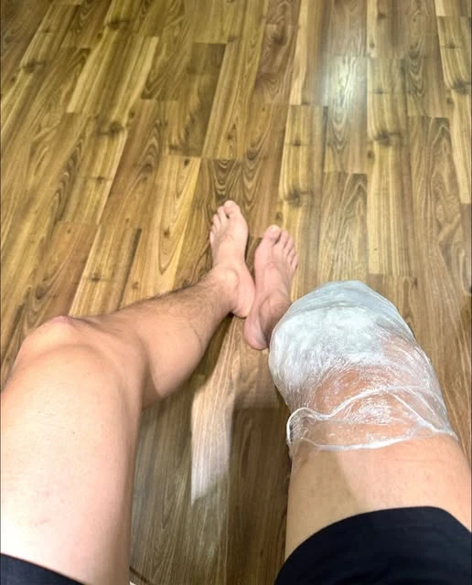 Tình trạng nghiêm trọng của nam thần VFC sau 1 năm bị đứt dây chằng chéo trước
