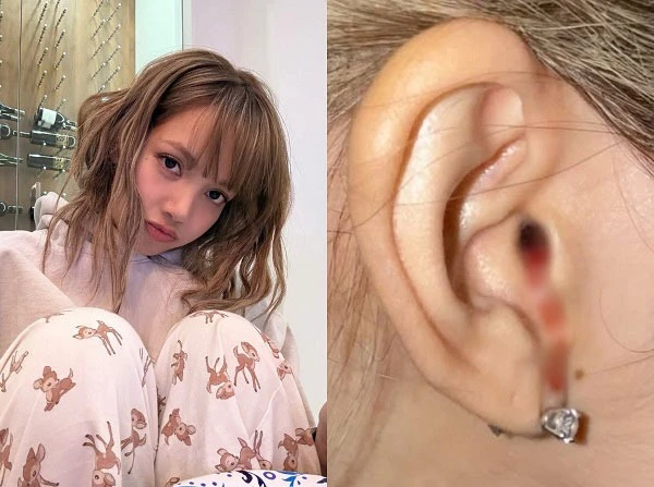 Lisa (BLACKPINK) lên tiếng về bức ảnh chảy máu tai gây hoang mang khắp MXH
