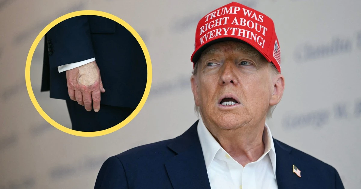 Dziwny wygląd dłoni Donalda Trumpa przykuł uwagę dziennikarzy. Biały Dom tłumaczy