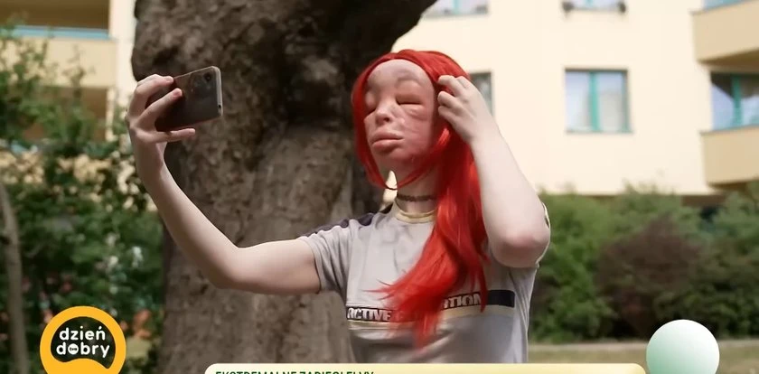 26-letnia Elva sama wstrzykiwała sobie silikon. Doszło do deformacji twarzy