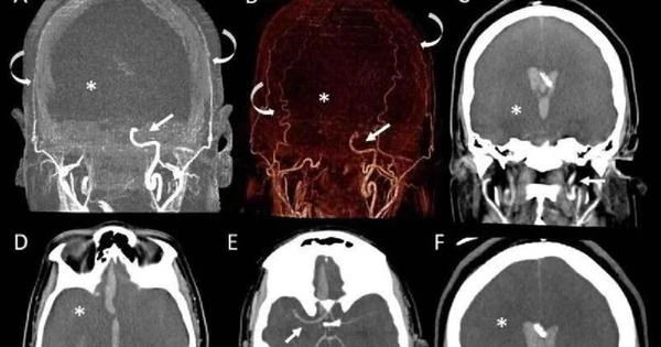 Caso raro: mulher com morte cerebral deu à luz bebê, relata estudo