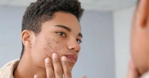 Cicatriz de acne aparece mais em homem com caso grave da doença