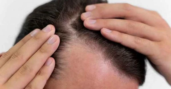Uberlândia irá sediar Instituto Brasileiro de Transplante Capilar