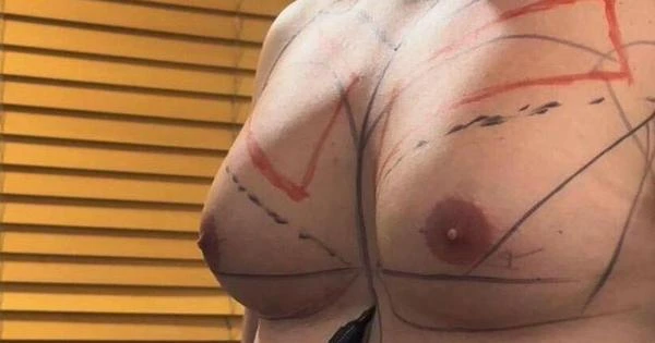 Ginecomastia: entenda a cirurgia realizada pelo ex-BBB Eliezer