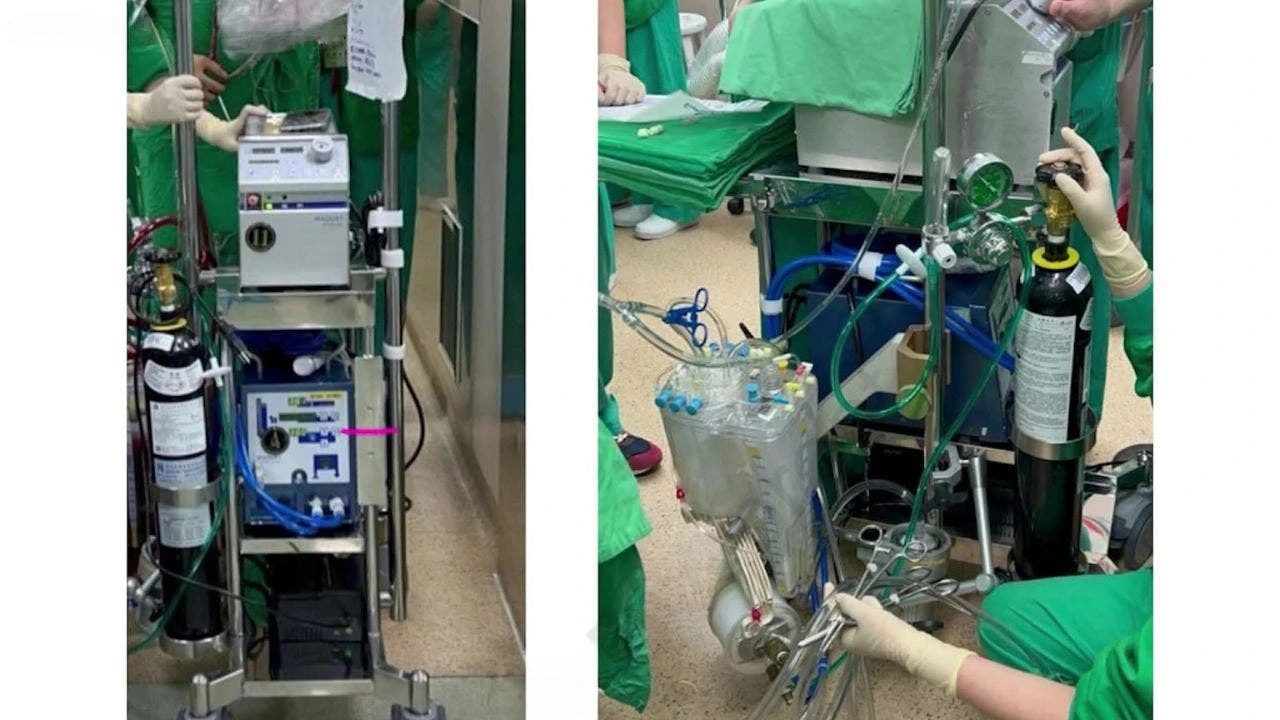 World’s first continuous beating heart transplant