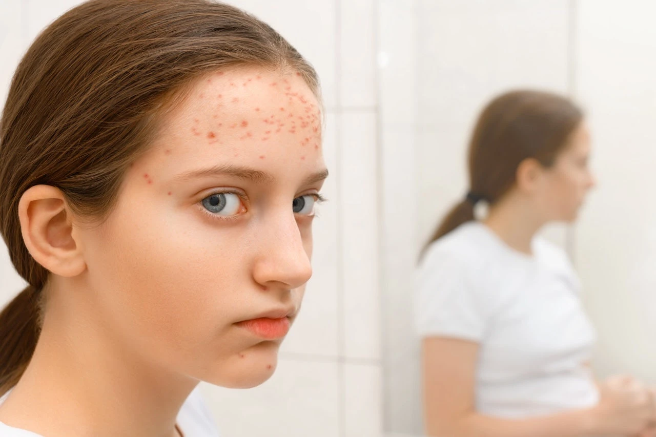 Amid measles outbreaks, Florida Department of Health speaks out against ‘false information’