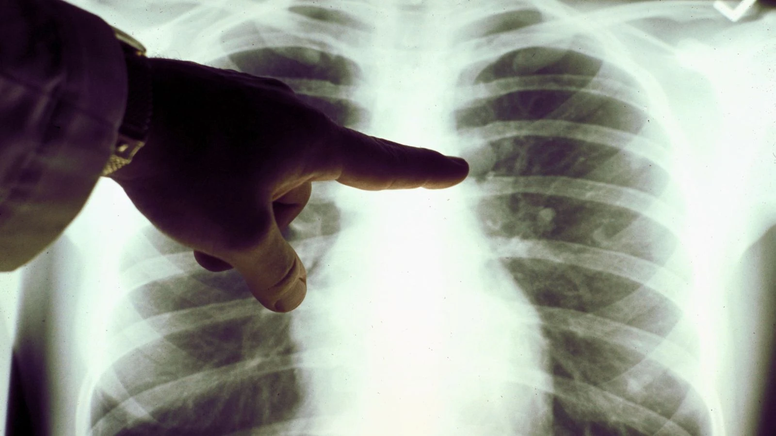 Lung cancers 'may have been misdiagnosed as COVID' during pandemic