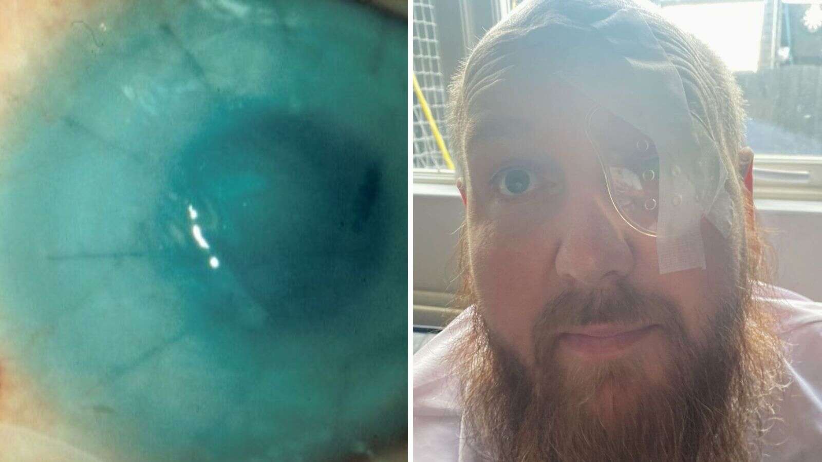 'It's unbelievable': Acid attack victim reveals how donated placenta saved his eye